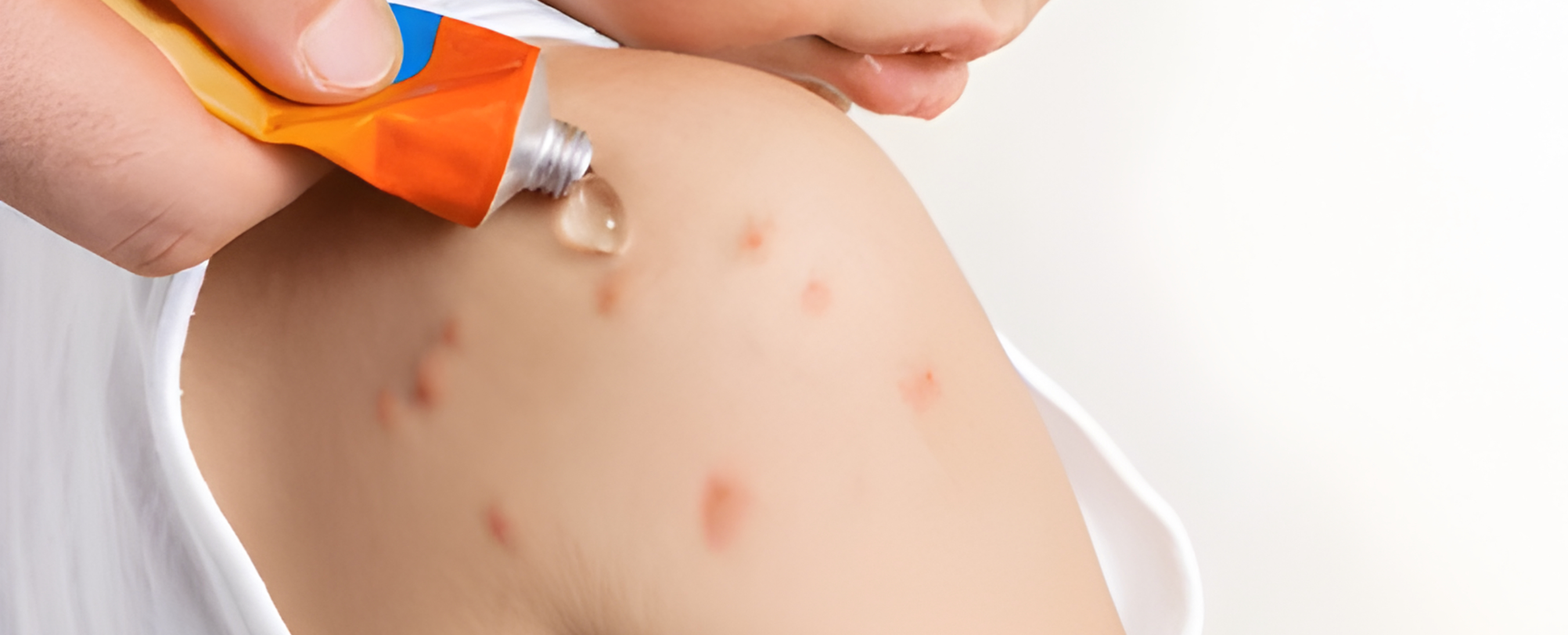 Future of Allergy Management