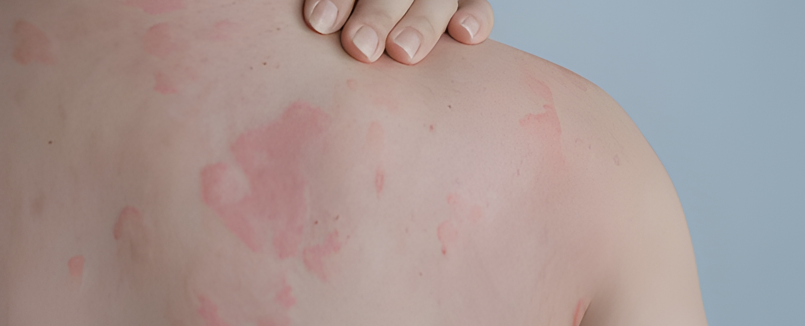 Preparing for Allergy Testing