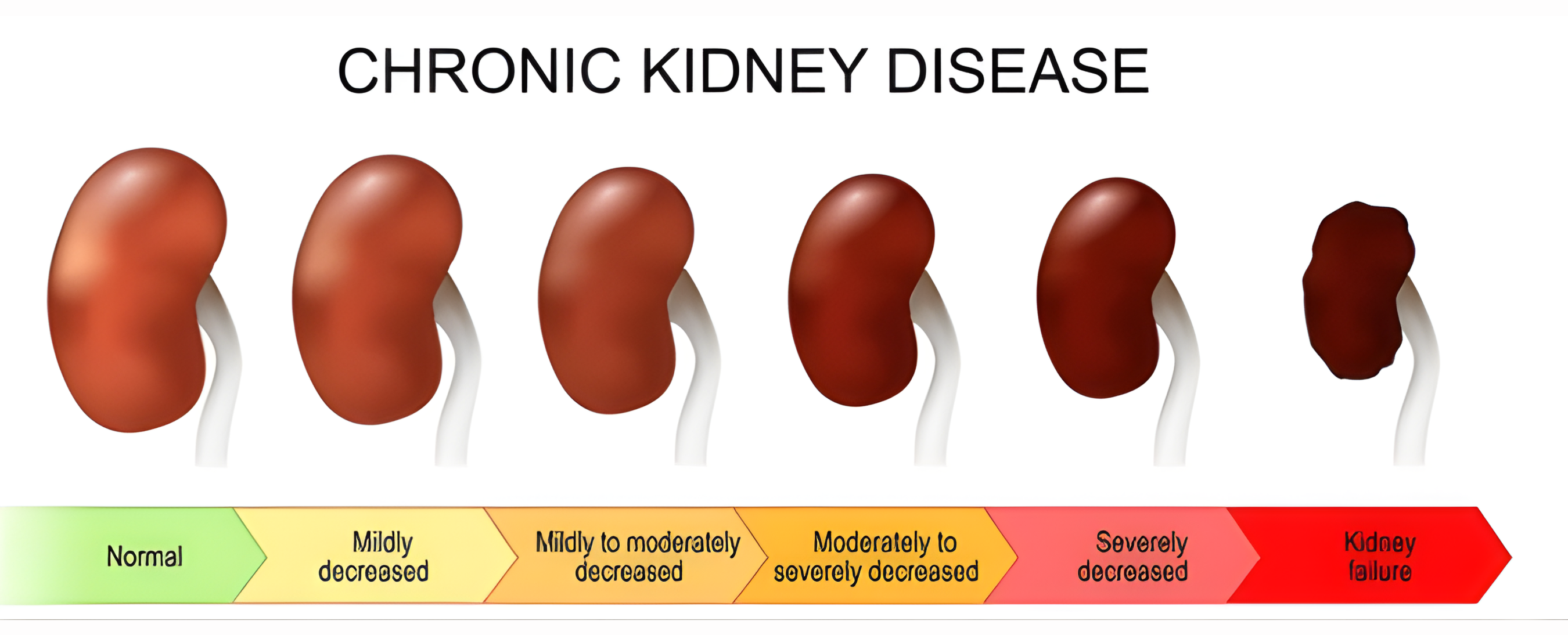 Common Kidney Conditions in Delhi NCR